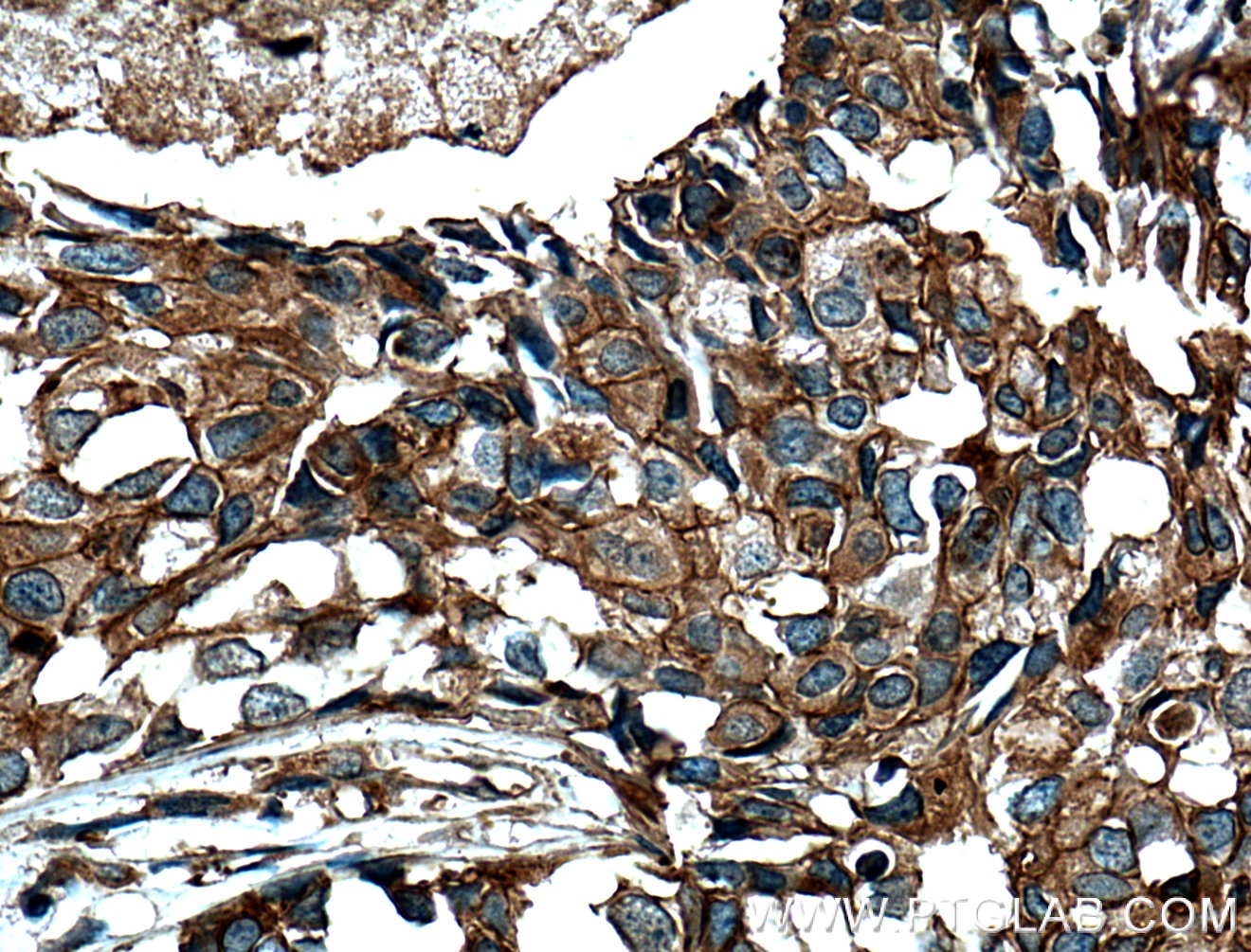 Immunohistochemistry (IHC) staining of human breast cancer tissue using FKBPL Monoclonal antibody (66389-1-Ig)