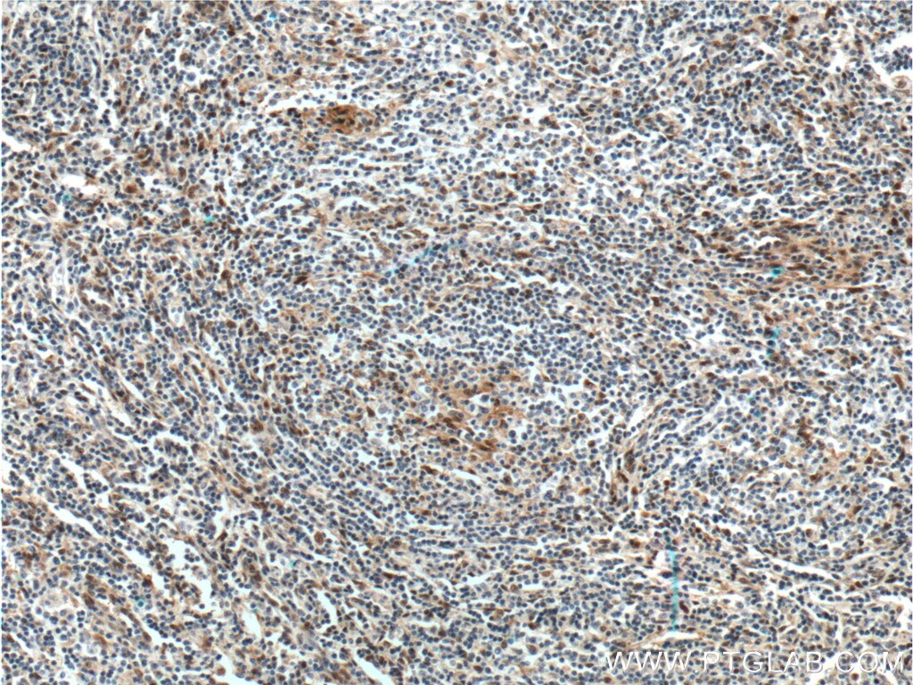Immunohistochemistry (IHC) staining of human lymphoma tissue using FLI1 Polyclonal antibody (11347-1-AP)