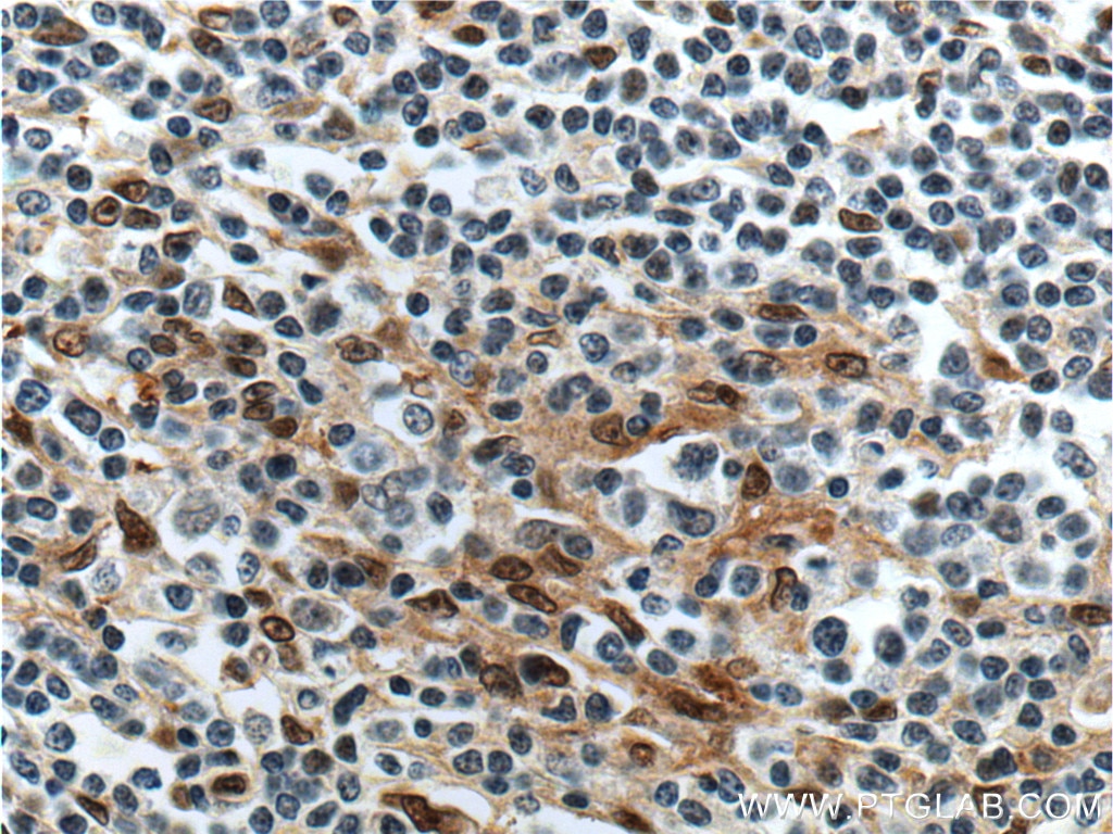 Immunohistochemistry (IHC) staining of human lymphoma tissue using FLI1 Polyclonal antibody (11347-1-AP)