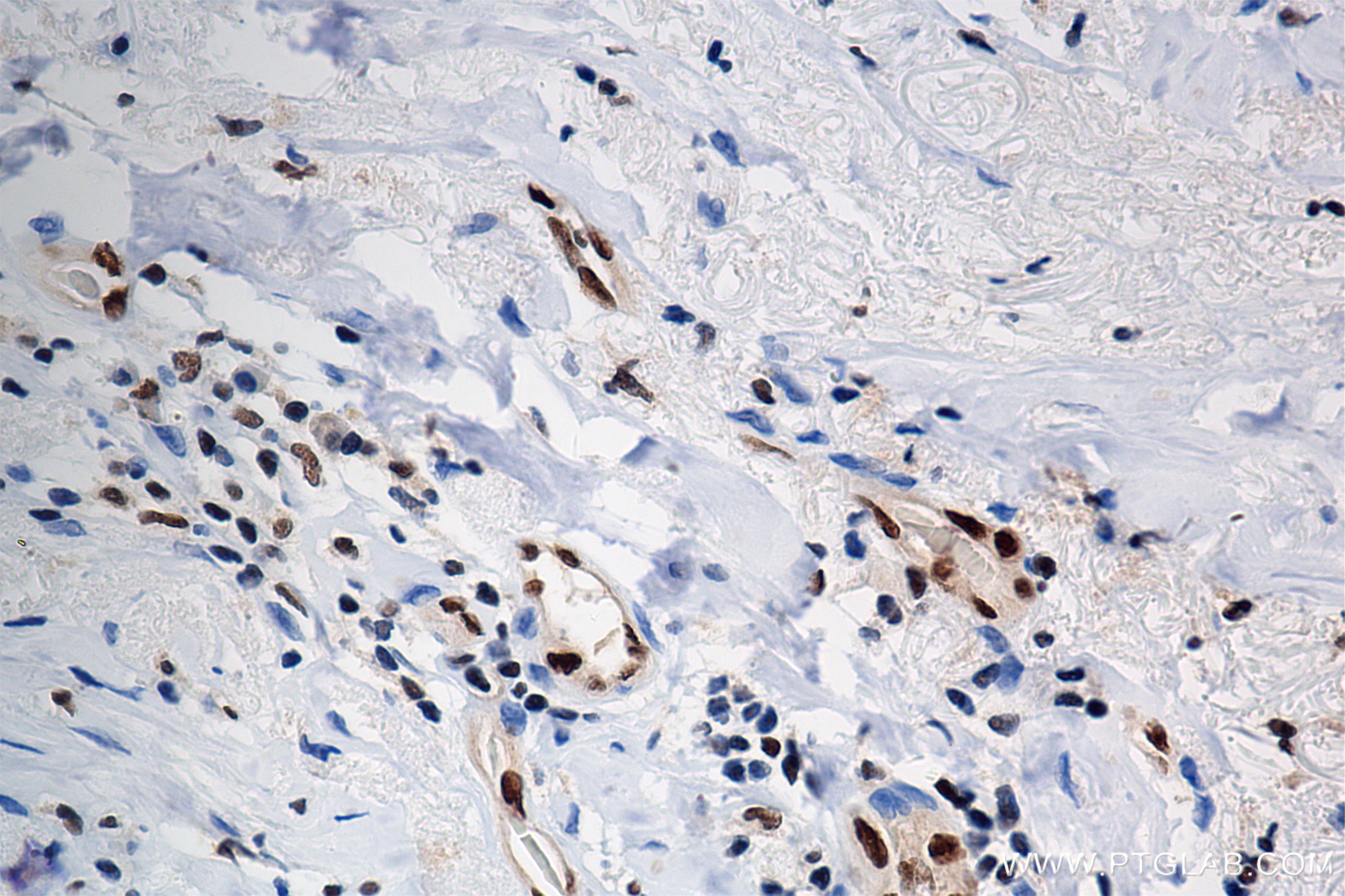 Immunohistochemistry (IHC) staining of human breast cancer tissue using FLI1 Recombinant antibody (85931-1-RR)