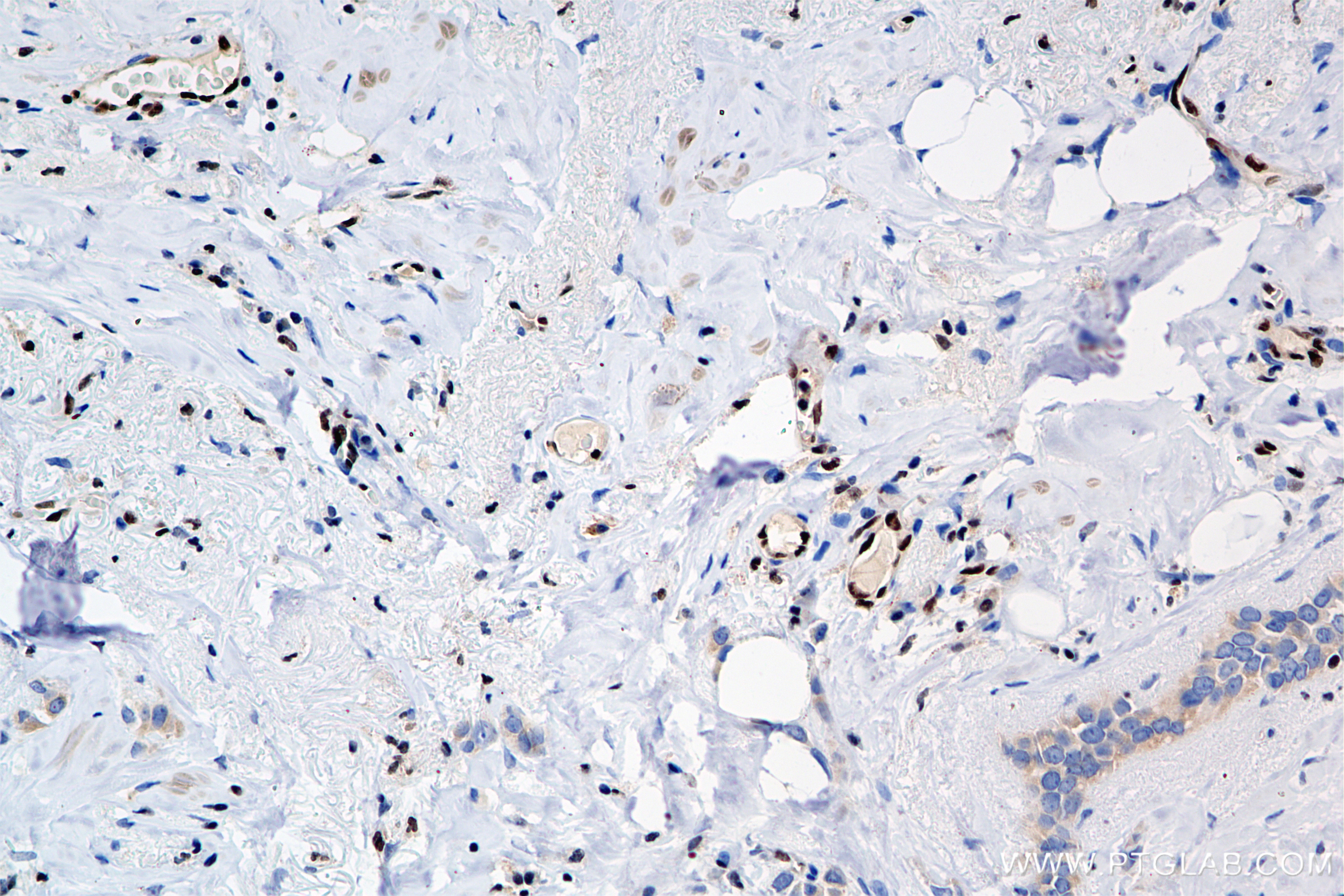 Immunohistochemistry (IHC) staining of human breast cancer tissue using FLI1 Recombinant antibody (85931-1-RR)