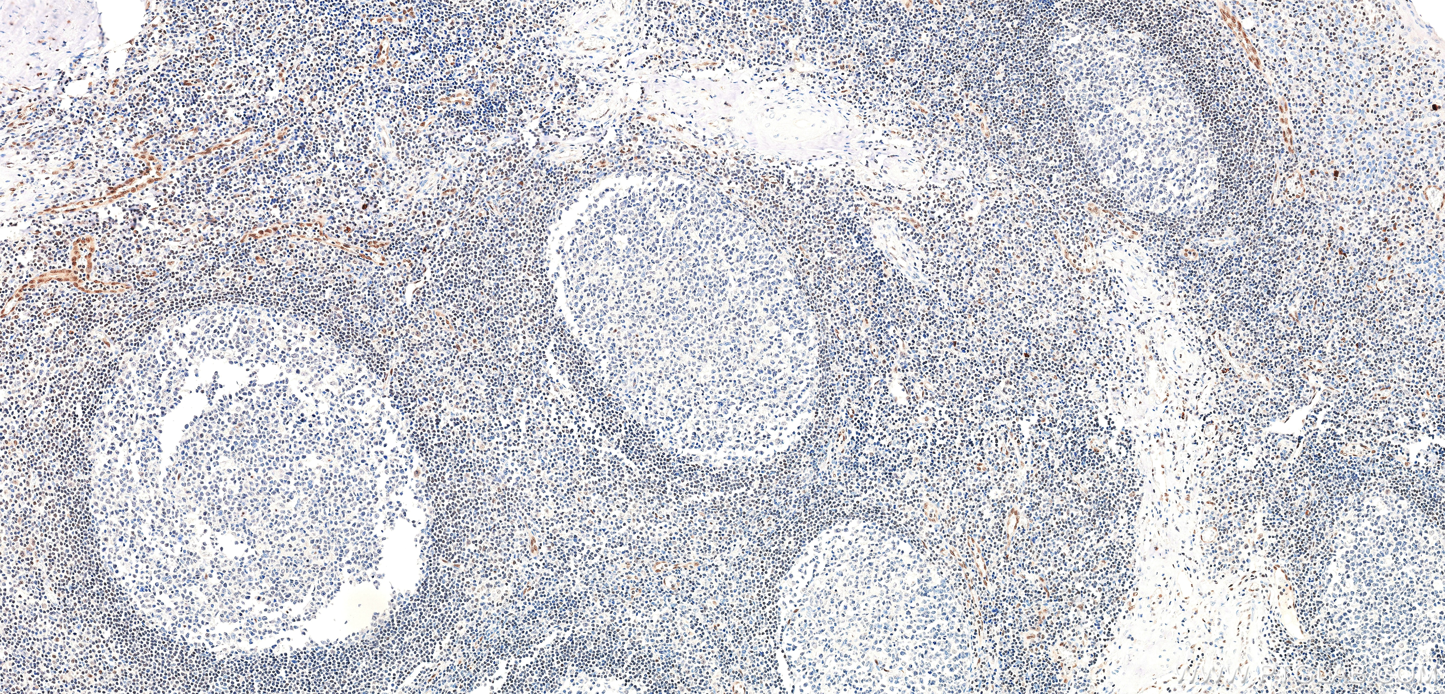 IHC staining of human tonsil using 85931-1-RR Immunohistochemistry (IHC) staining of human tonsil tissue using FLI1 Recombinant monoclonal antibody (85931-1-RR)