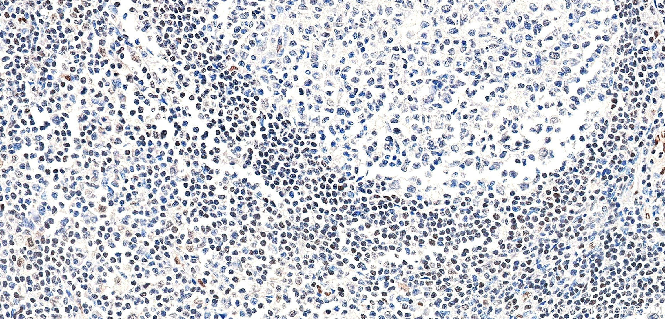 IHC staining of human tonsil using 85931-1-RR Immunohistochemistry (IHC) staining of human tonsil tissue using FLI1 Recombinant monoclonal antibody (85931-1-RR)