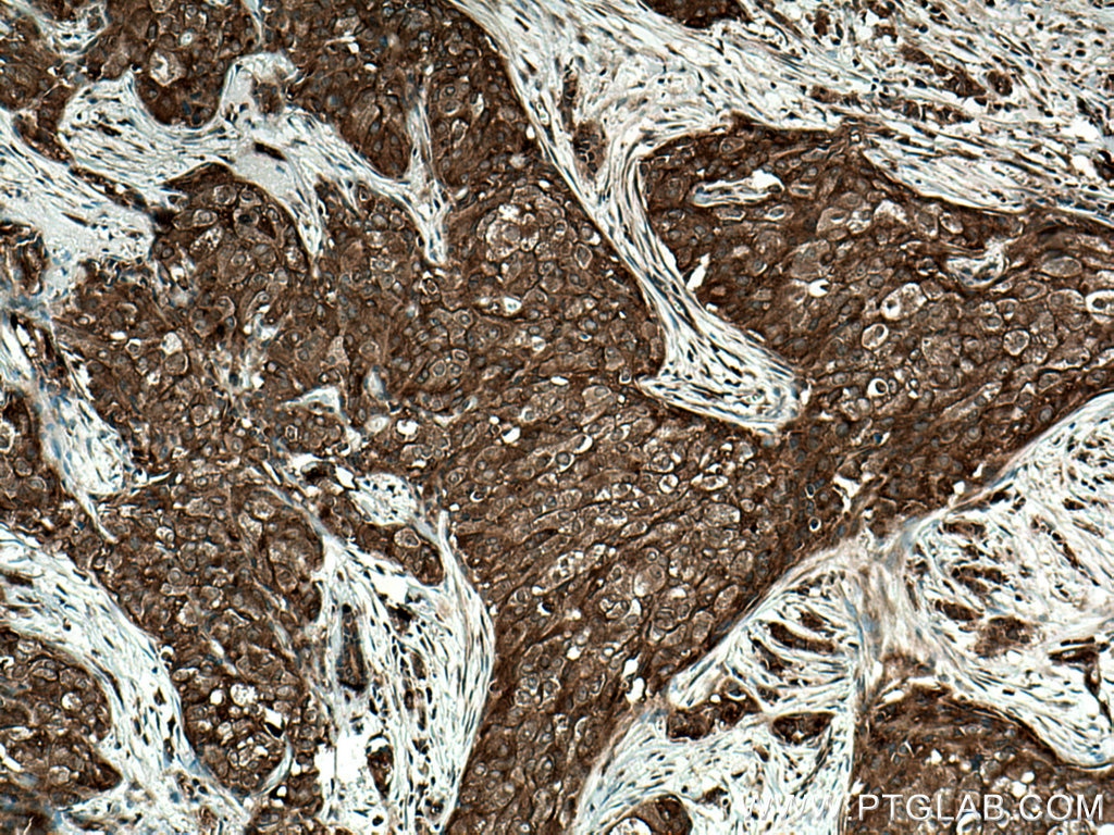 IHC staining of human breast cancer using 67039-1-Ig