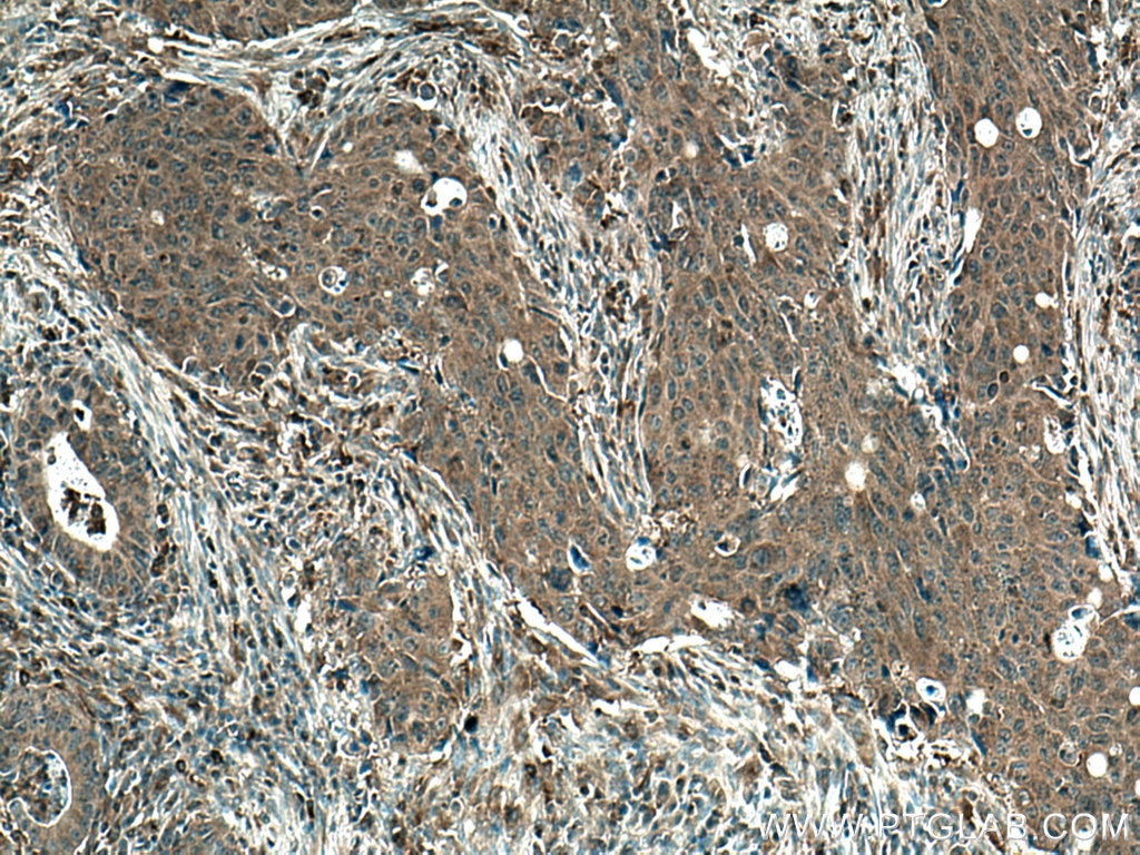 Immunohistochemistry (IHC) staining of human colon cancer tissue using Flightless I Monoclonal antibody (67039-1-Ig)
