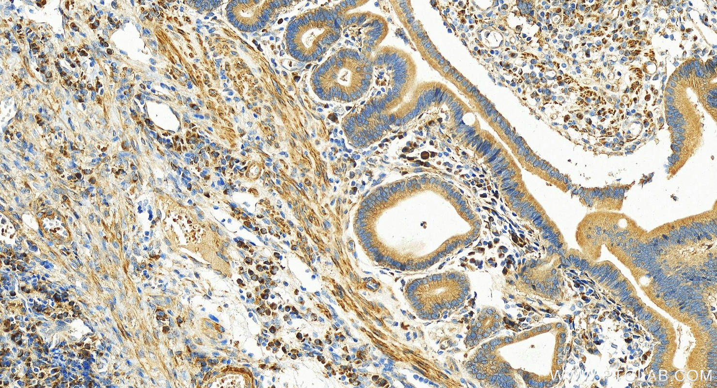 Immunohistochemistry (IHC) staining of human stomach cancer tissue using FLJ14213 Polyclonal antibody (26355-1-AP)
