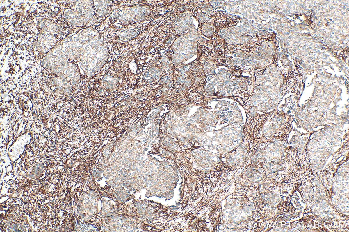 IHC staining of human breast cancer using 11140-1-AP Immunohistochemistry (IHC) staining of human breast cancer tissue using Filamin A Polyclonal antibody (11140-1-AP)