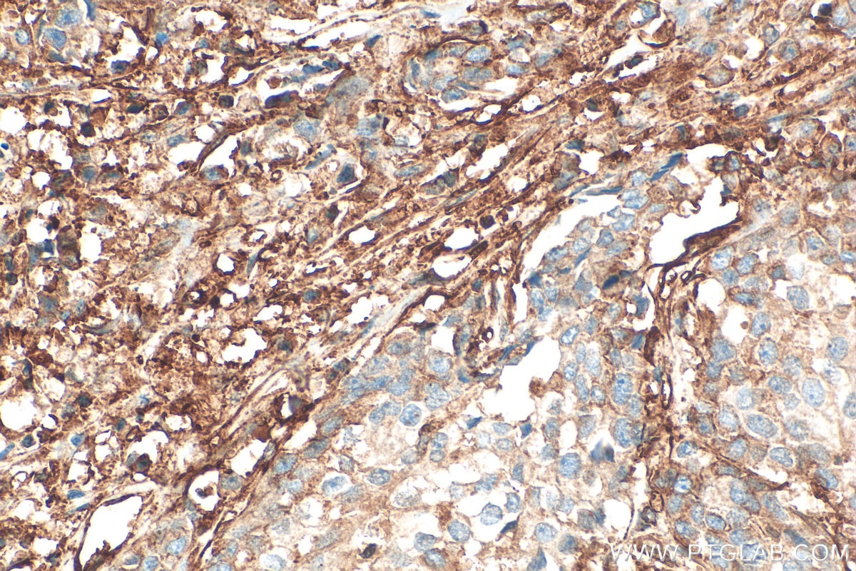 IHC staining of human breast cancer using 11140-1-AP Immunohistochemistry (IHC) staining of human breast cancer tissue using Filamin A Polyclonal antibody (11140-1-AP)