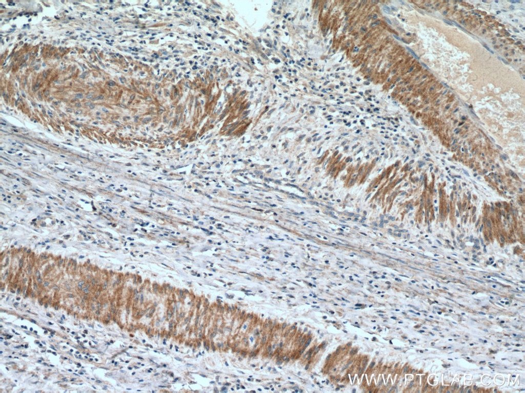 Immunohistochemistry (IHC) staining of human cervical cancer tissue using FLNA Monoclonal antibody (67133-1-Ig)
