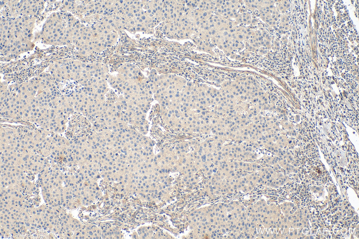 Immunohistochemistry (IHC) staining of human breast cancer tissue using FLNA Monoclonal antibody (67133-1-Ig)