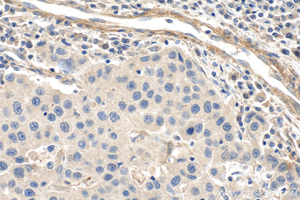Immunohistochemistry (IHC) staining of human breast cancer tissue using FLNA Monoclonal antibody (67133-1-Ig)