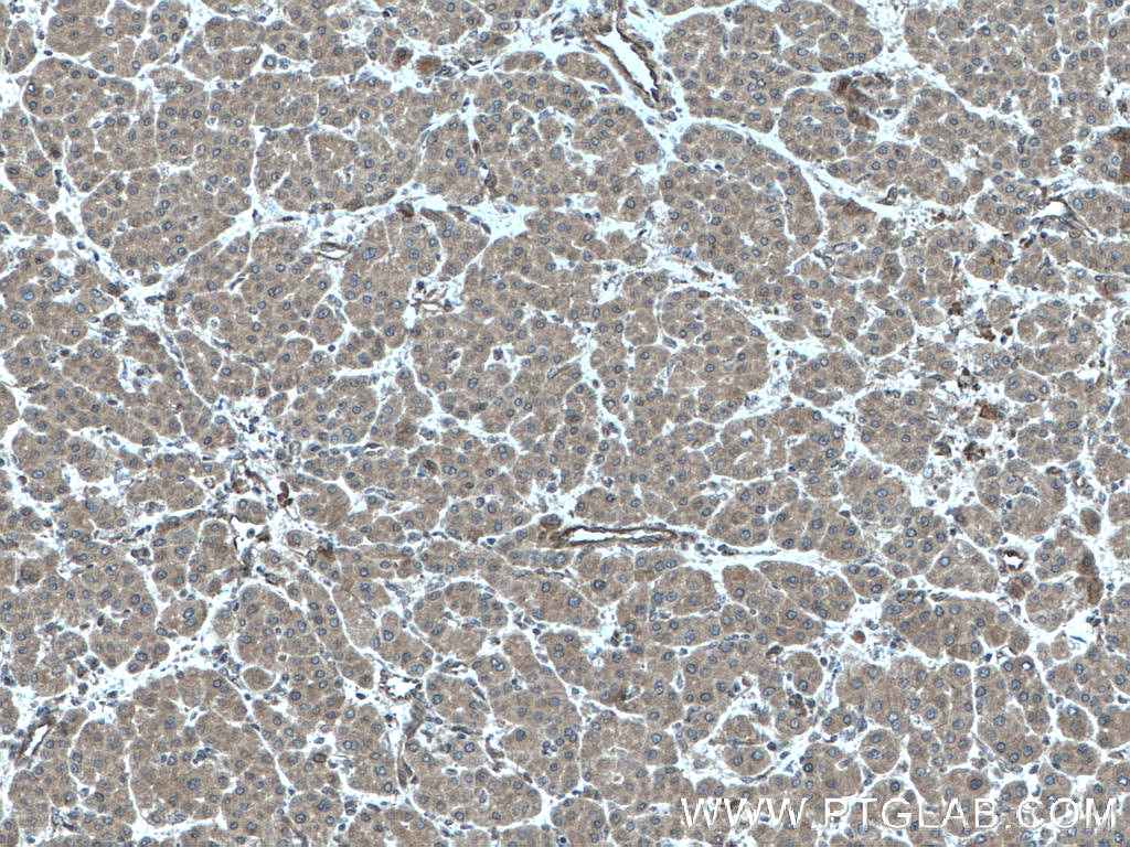 IHC staining of human liver cancer using 20685-1-AP