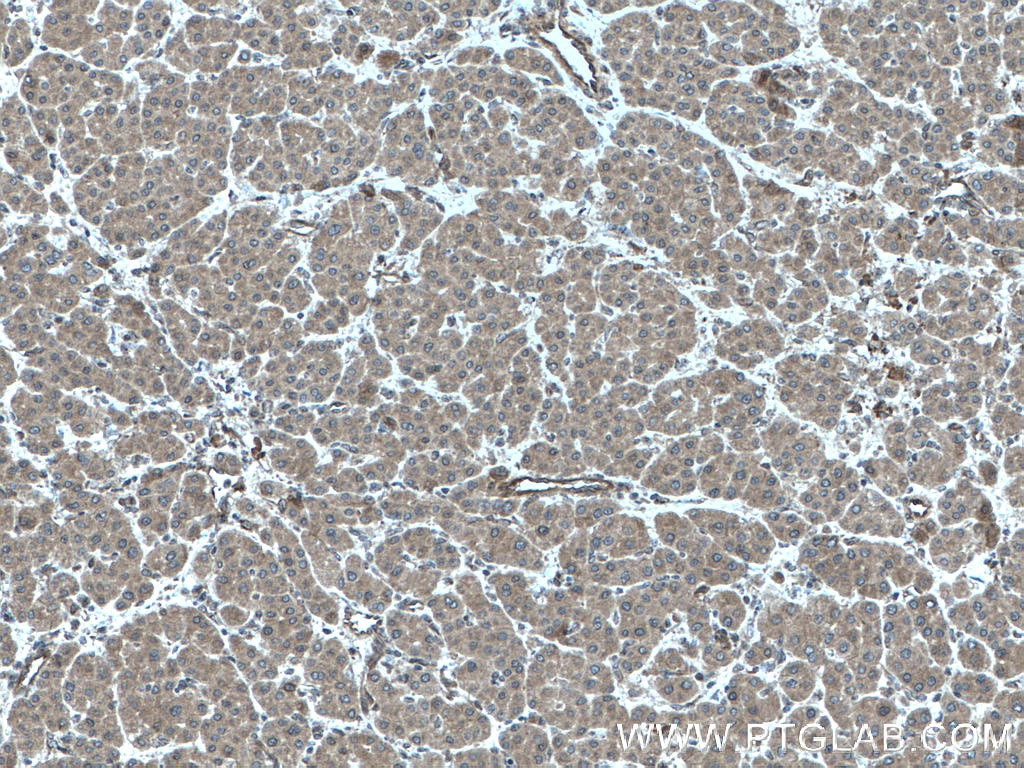 Immunohistochemistry (IHC) staining of human liver cancer tissue using FLNB Polyclonal antibody (20685-1-AP)