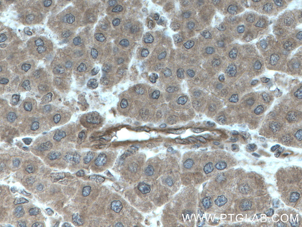 Immunohistochemistry (IHC) staining of human liver cancer tissue using FLNB Polyclonal antibody (20685-1-AP)