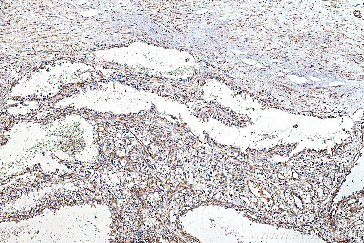 Immunohistochemistry (IHC) staining of human renal cell carcinoma tissue using VEGFR-1/FLT-1 Polyclonal antibody (13687-1-AP)