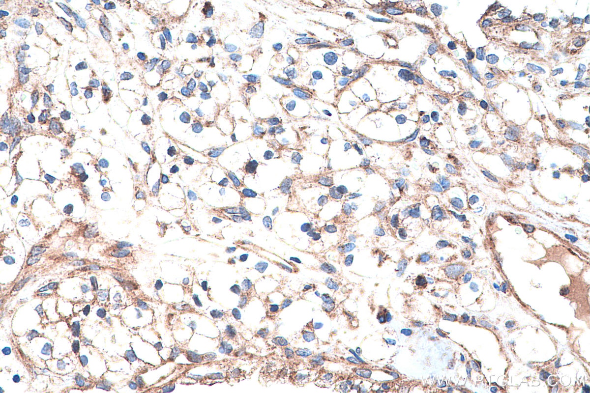 IHC staining of human renal cell carcinoma using 13687-1-AP