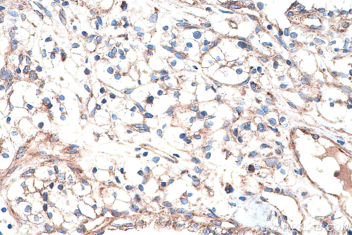 Immunohistochemistry (IHC) staining of human renal cell carcinoma tissue using VEGFR-1/FLT-1 Polyclonal antibody (13687-1-AP)