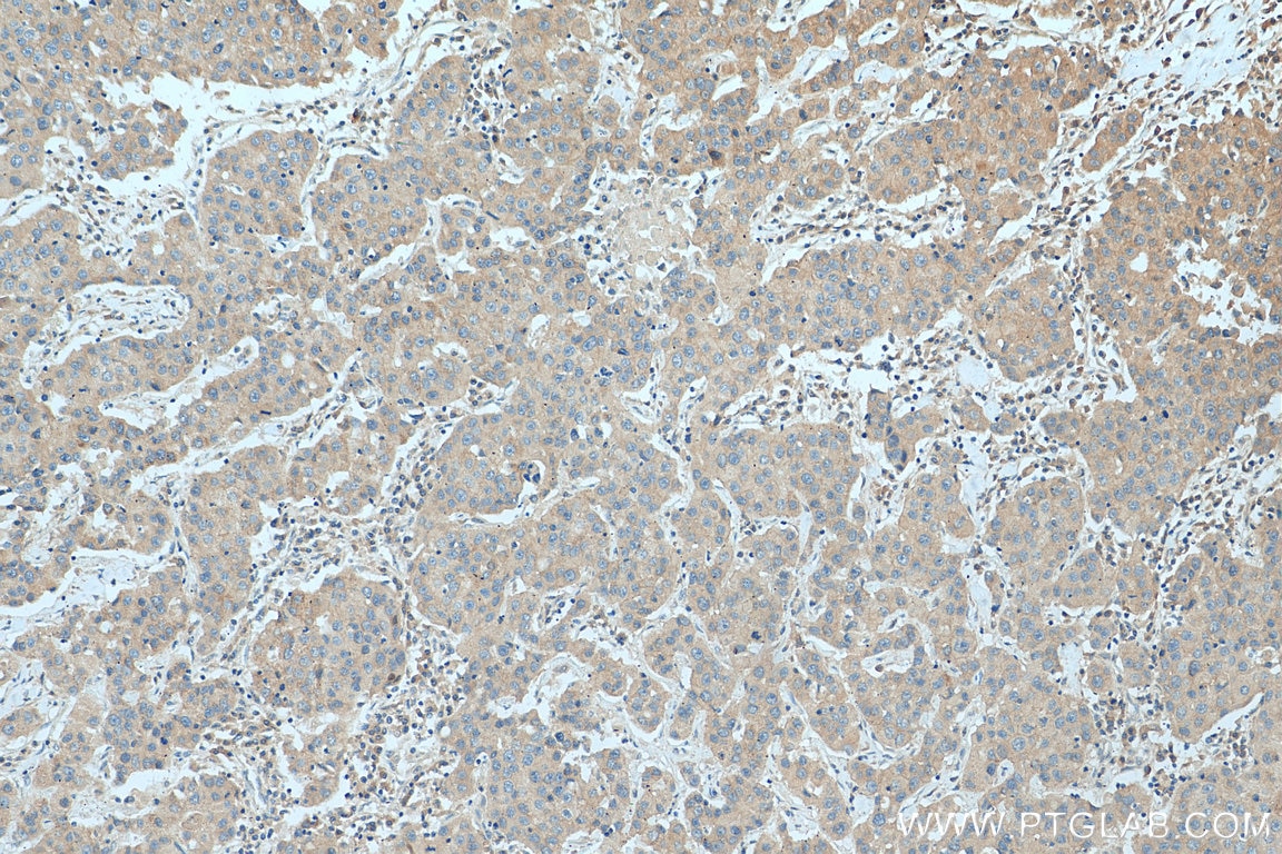 Immunohistochemistry (IHC) staining of human breast cancer tissue using FLVCR1 Polyclonal antibody (26841-1-AP)