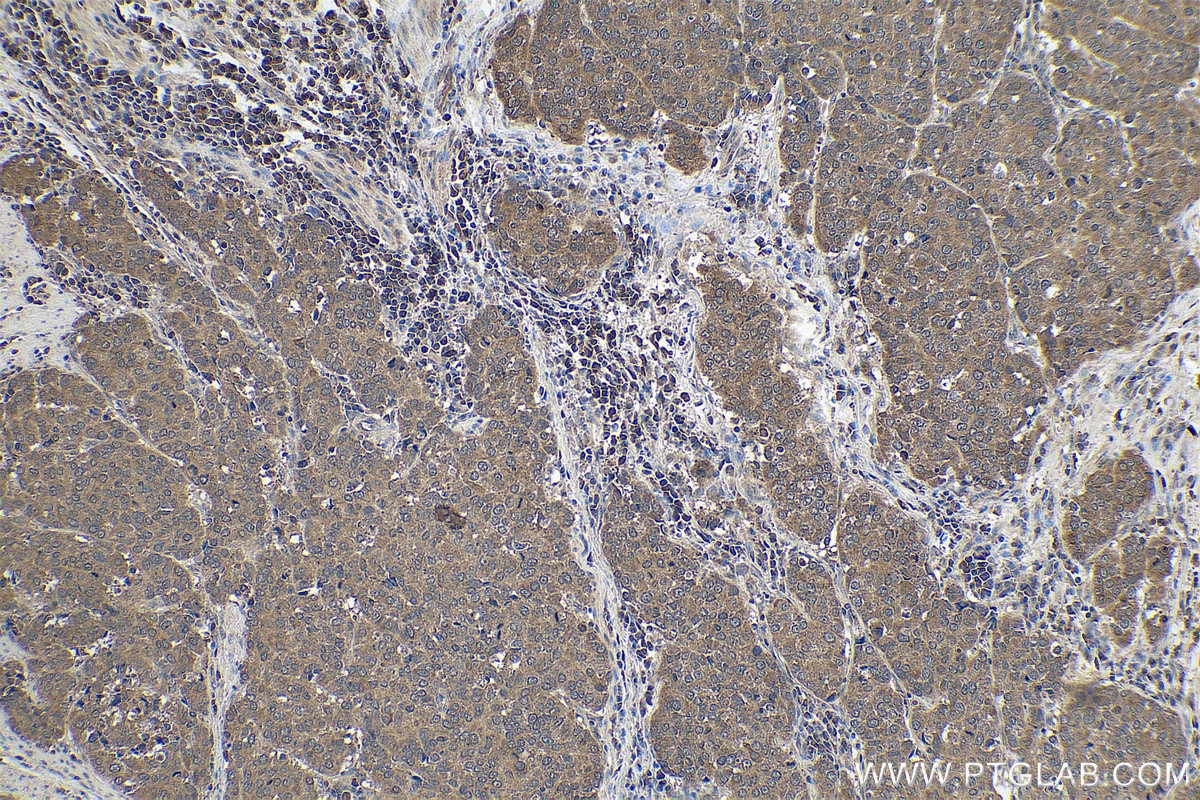 Immunohistochemistry (IHC) staining of human stomach cancer tissue using FLYWCH2 Polyclonal antibody (24228-1-AP)