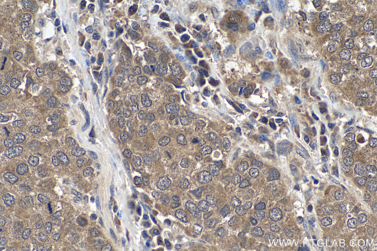 Immunohistochemistry (IHC) staining of human stomach cancer tissue using FLYWCH2 Polyclonal antibody (24228-1-AP)