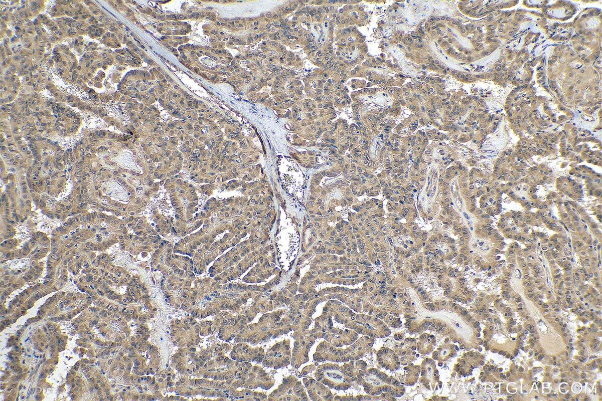 Immunohistochemistry (IHC) staining of human thyroid cancer tissue using FLYWCH2 Polyclonal antibody (24228-1-AP)