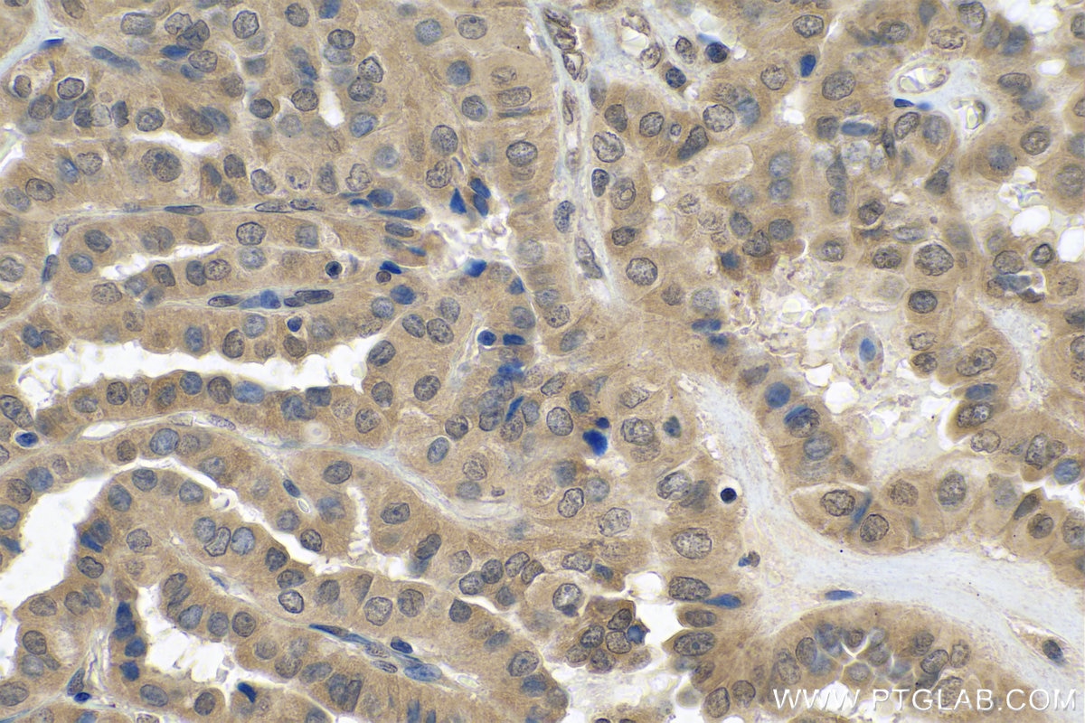 Immunohistochemistry (IHC) staining of human thyroid cancer tissue using FLYWCH2 Polyclonal antibody (24228-1-AP)