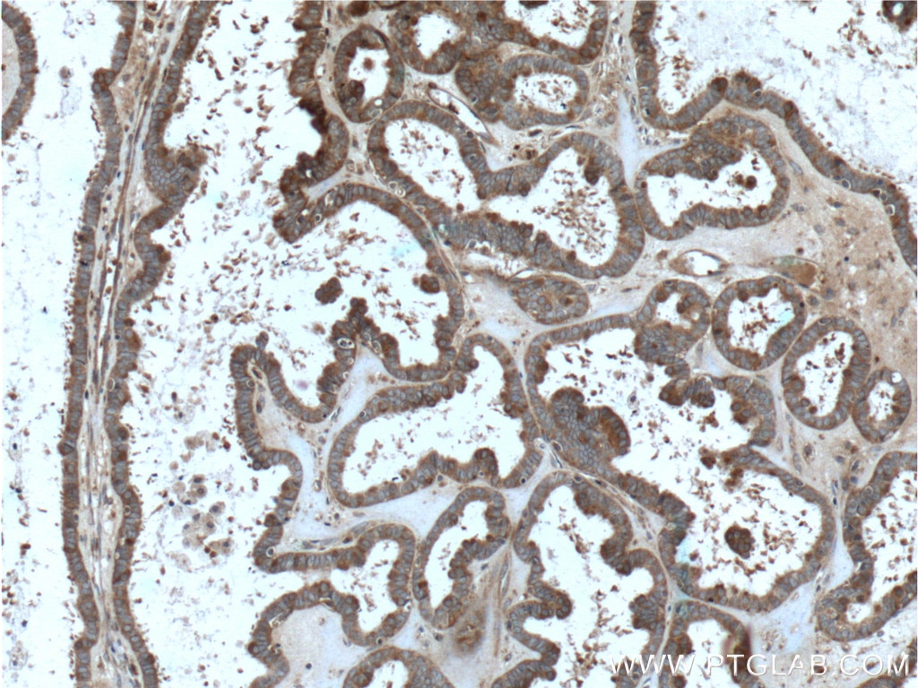 Immunohistochemistry (IHC) staining of human ovary tumor tissue using FMN2 Polyclonal antibody (11259-1-AP)