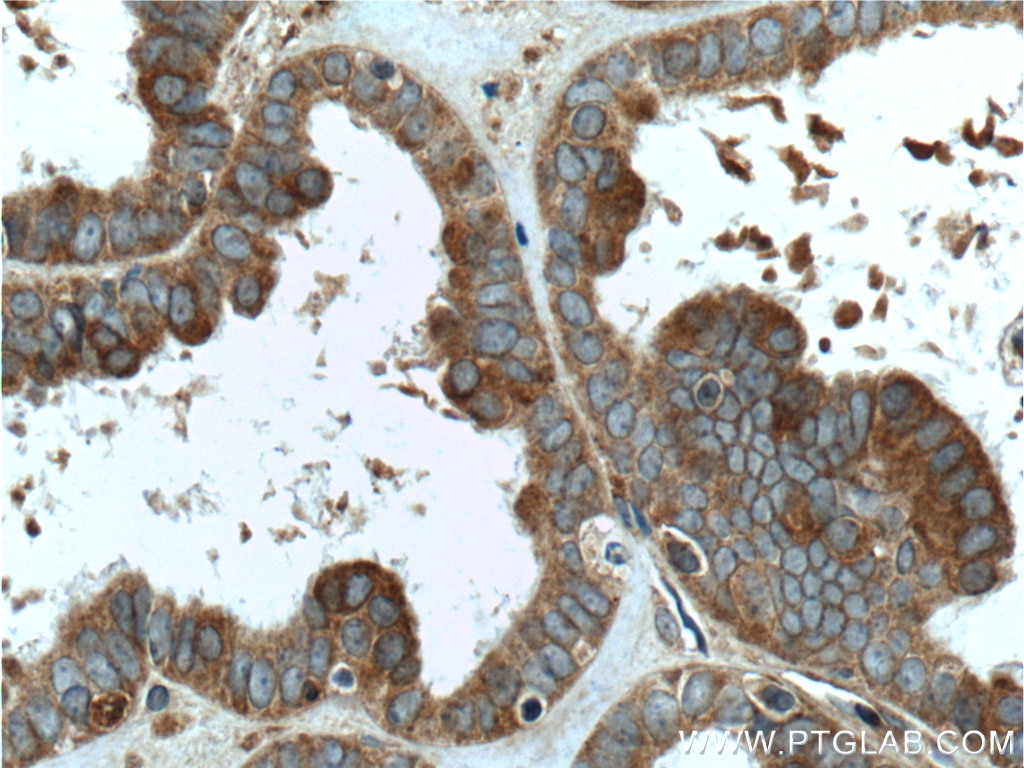 Immunohistochemistry (IHC) staining of human ovary tumor tissue using FMN2 Polyclonal antibody (11259-1-AP)