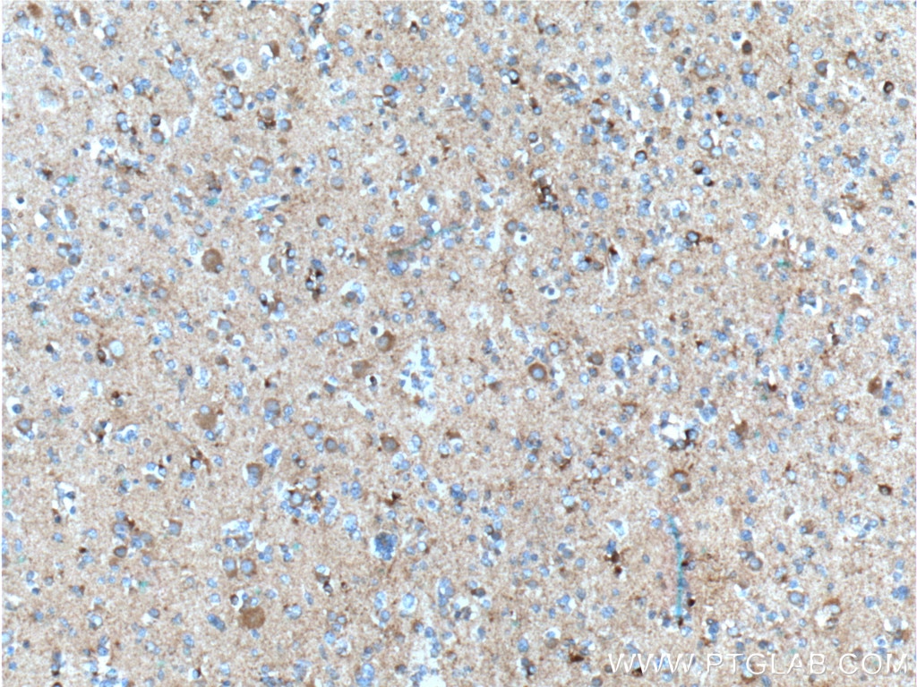 IHC staining of human gliomas using 11259-1-AP