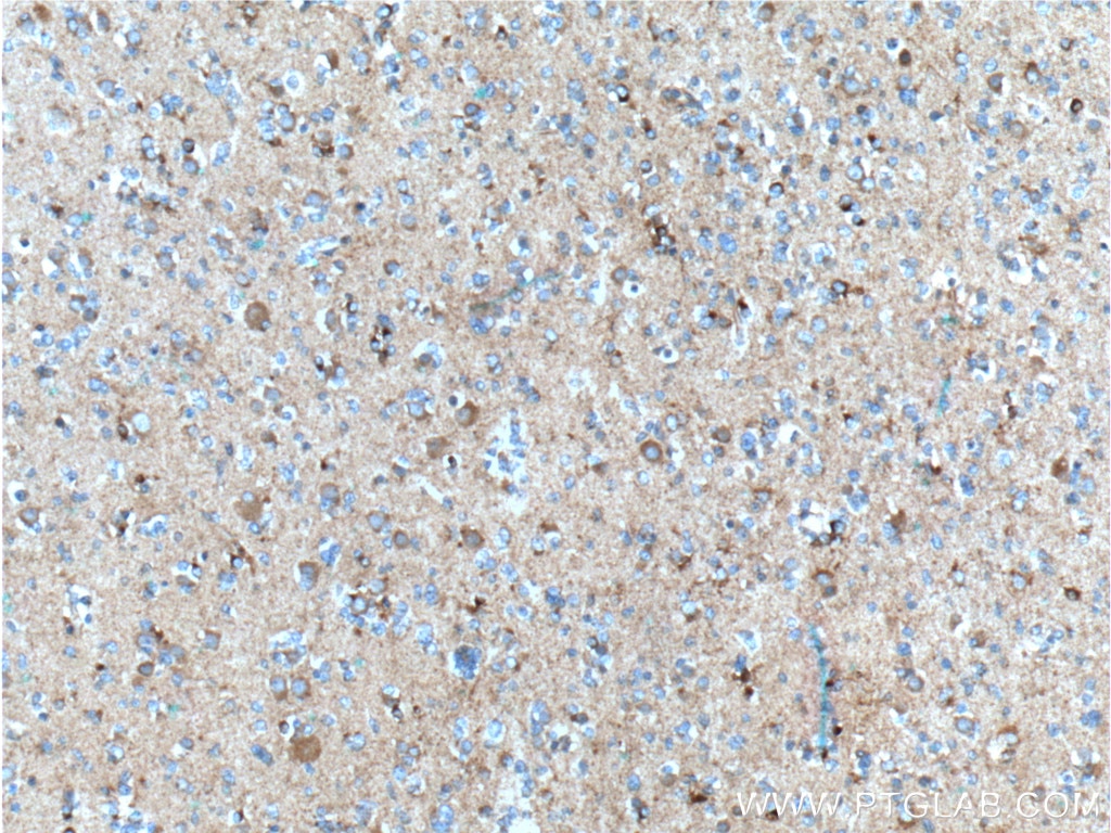 Immunohistochemistry (IHC) staining of human gliomas tissue using FMN2 Polyclonal antibody (11259-1-AP)