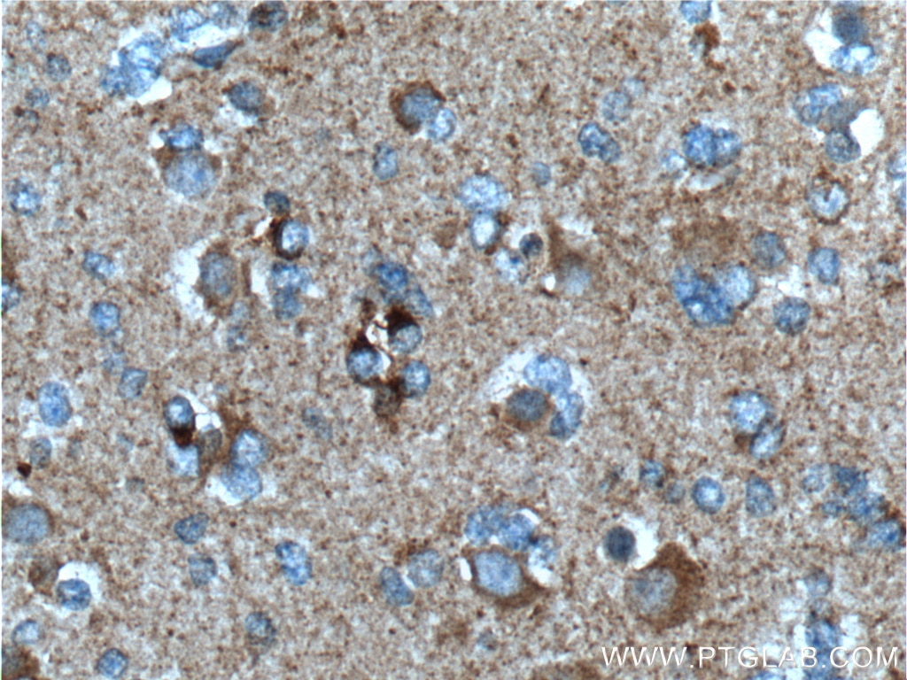 Immunohistochemistry (IHC) staining of human gliomas tissue using FMN2 Polyclonal antibody (11259-1-AP)