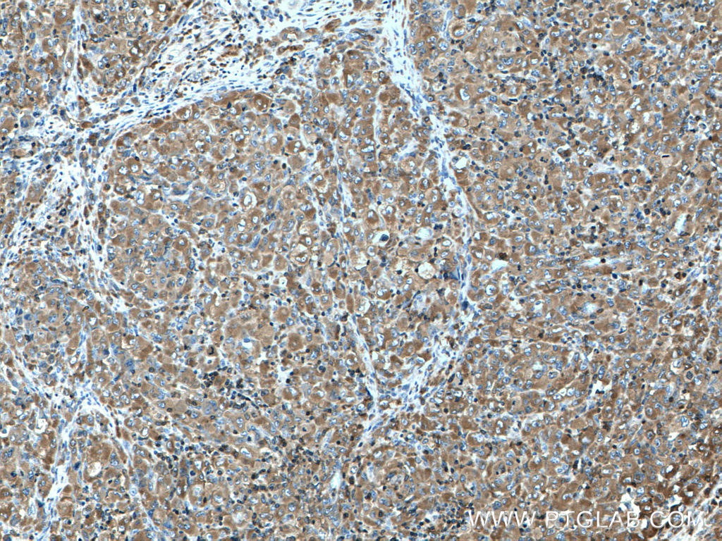Immunohistochemistry (IHC) staining of human lymphoma tissue using FMNL1 Polyclonal antibody (27834-1-AP)