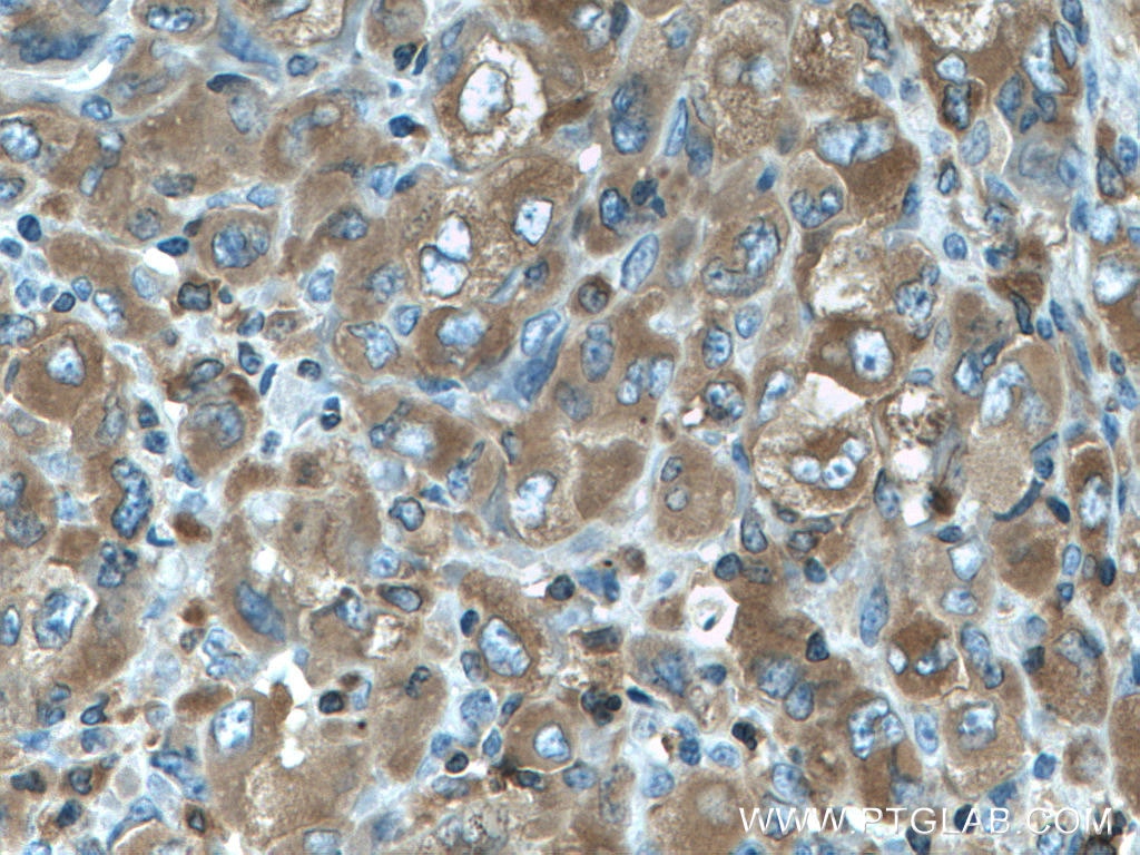 Immunohistochemistry (IHC) staining of human lymphoma tissue using FMNL1 Polyclonal antibody (27834-1-AP)