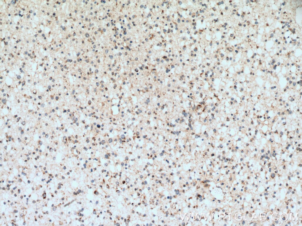 IHC staining of human gliomas using 13038-1-AP