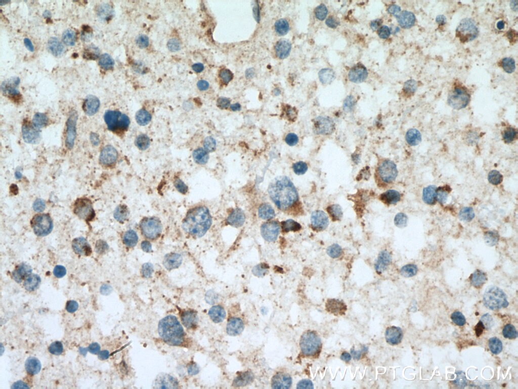 Immunohistochemistry (IHC) staining of human gliomas tissue using FMNL2 Polyclonal antibody (13038-1-AP)