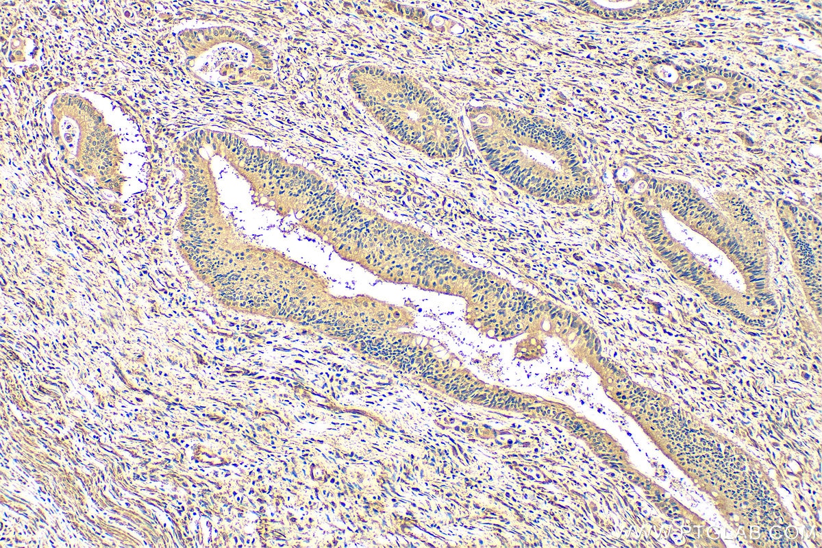 Immunohistochemistry (IHC) staining of human colon cancer tissue using FMNL3 Polyclonal antibody (29756-1-AP)