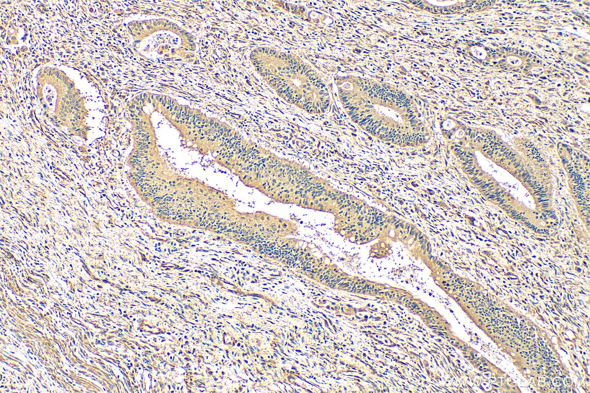 Immunohistochemistry (IHC) staining of human colon cancer tissue using FMNL3 Polyclonal antibody (29756-1-AP)