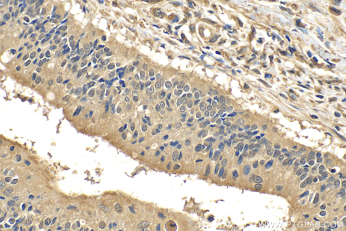 Immunohistochemistry (IHC) staining of human colon cancer tissue using FMNL3 Polyclonal antibody (29756-1-AP)