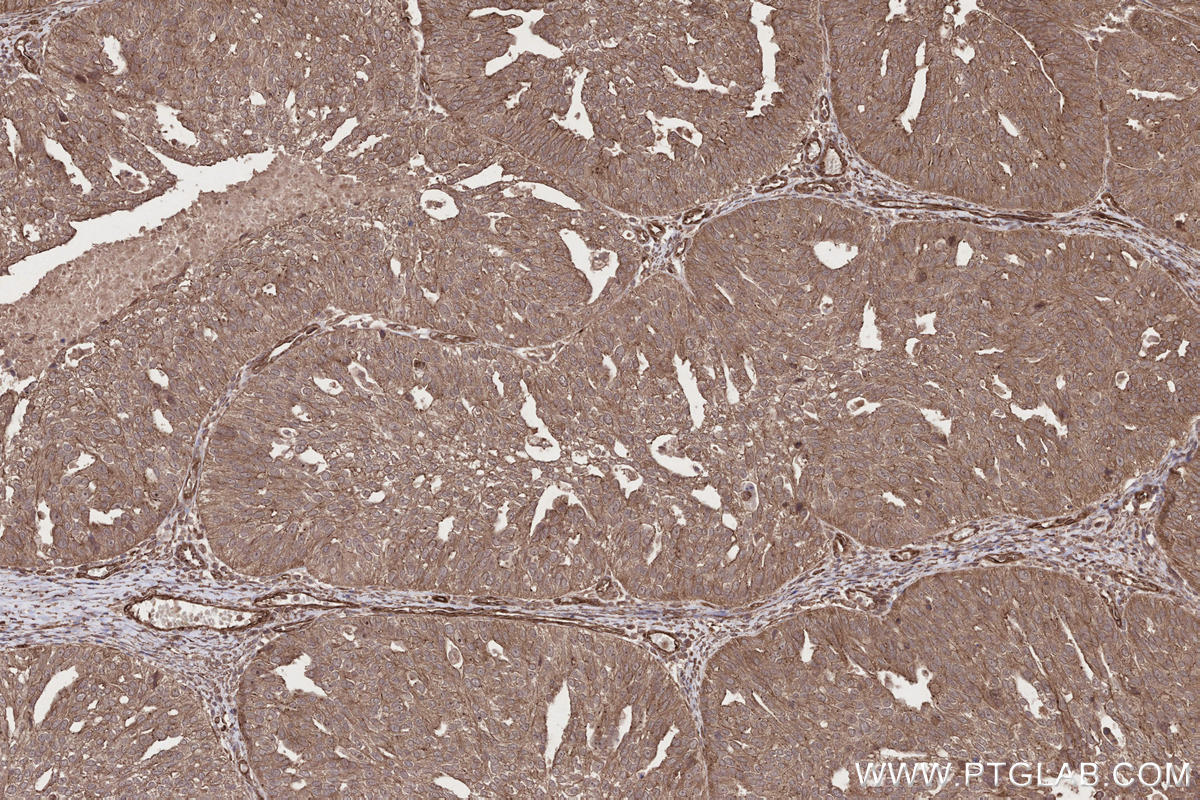 IHC staining of human ovary cancer using 29756-1-AP Immunohistochemistry (IHC) staining of human ovary cancer tissue using FMNL3 Polyclonal antibody (29756-1-AP)