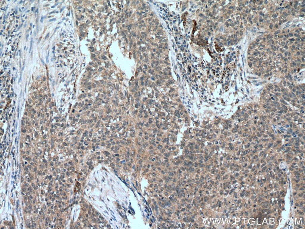 Immunohistochemistry (IHC) staining of human lung cancer tissue using FMO2 Polyclonal antibody (15725-1-AP)