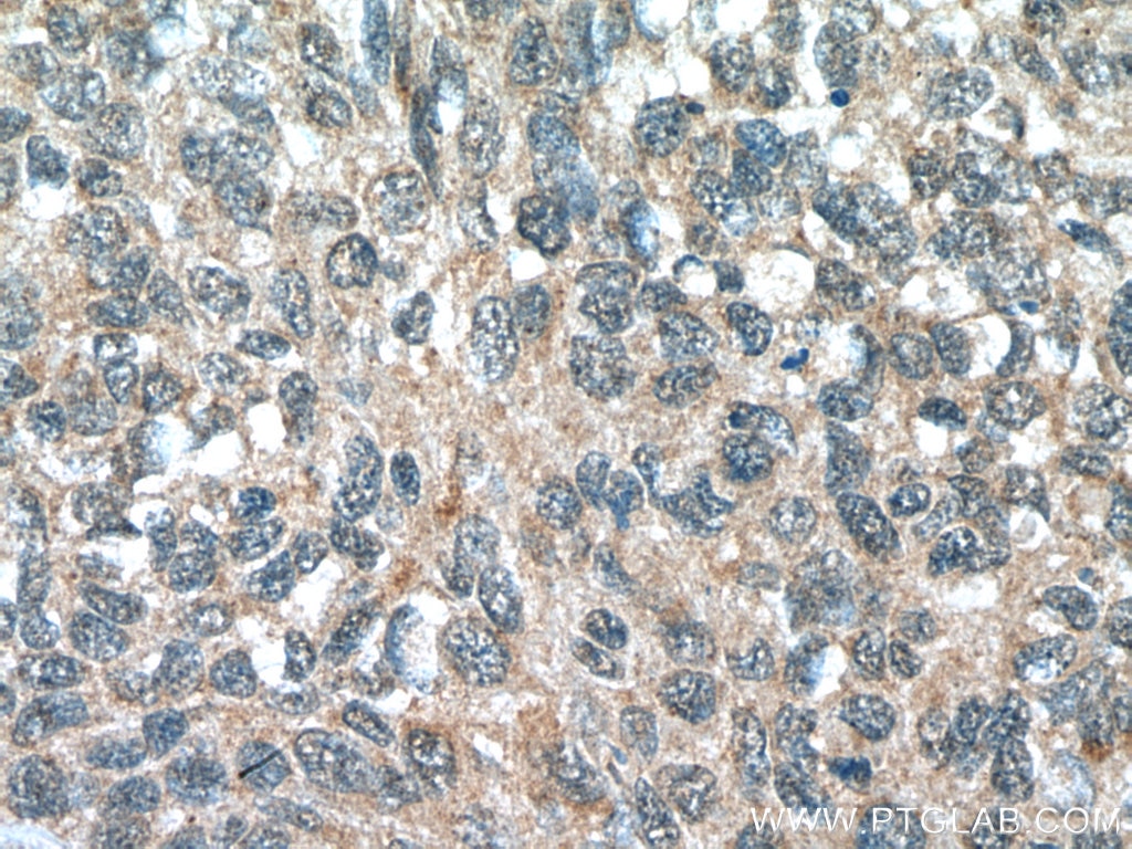 Immunohistochemistry (IHC) staining of human lung cancer tissue using FMO2 Polyclonal antibody (15725-1-AP)