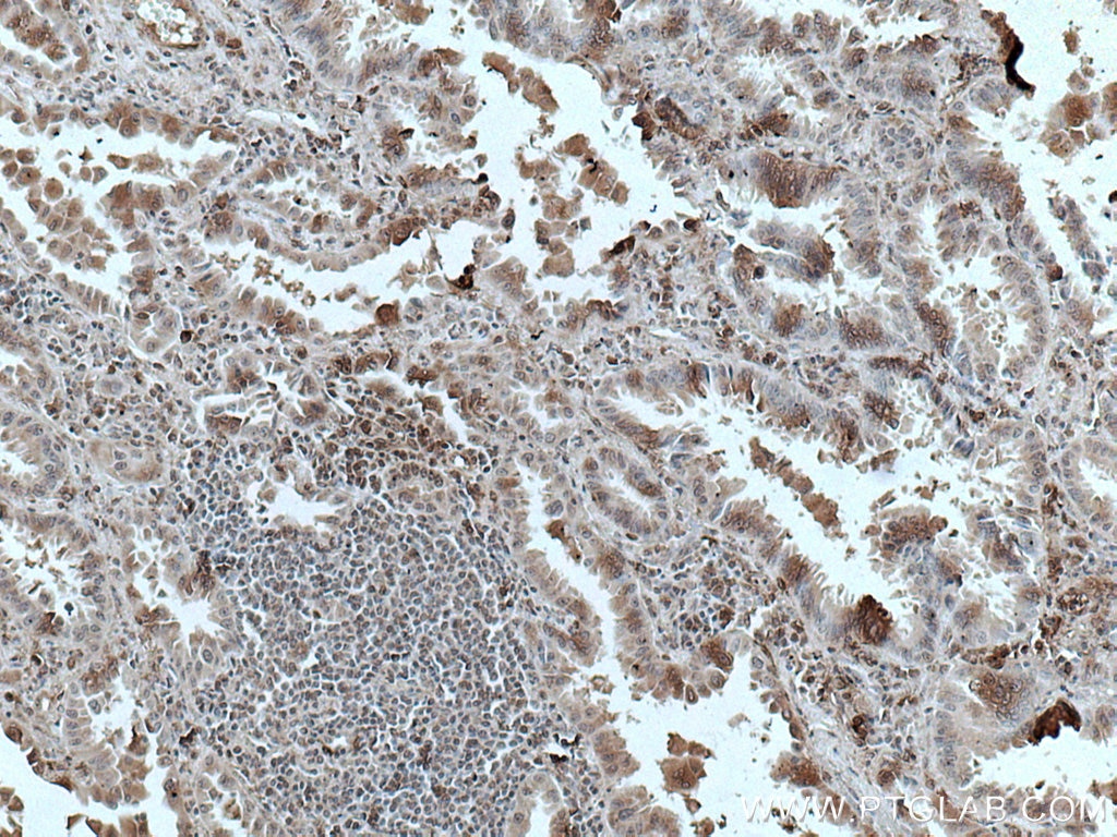 Immunohistochemistry (IHC) staining of human lung cancer tissue using FMO2 Monoclonal antibody (67019-1-Ig)