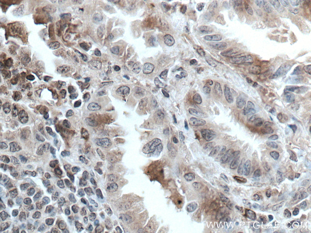 Immunohistochemistry (IHC) staining of human lung cancer tissue using FMO2 Monoclonal antibody (67019-1-Ig)