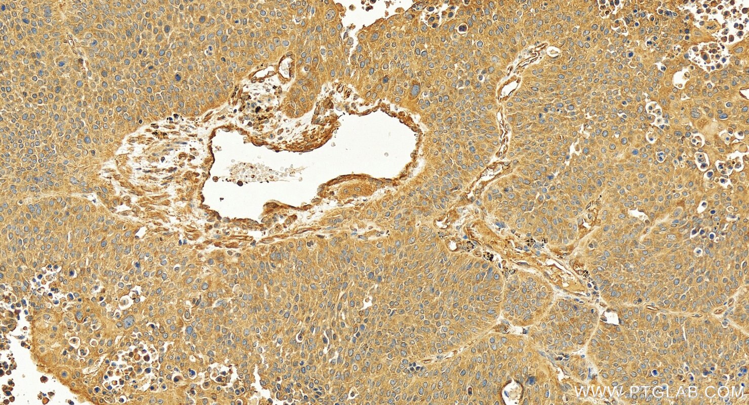 Immunohistochemistry (IHC) staining of human lung squamous cell cancer using FMO2-specific Polyclonal antibody (16861-1-AP)