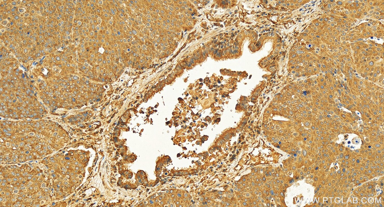 Immunohistochemistry (IHC) staining of human lung squamous cell cancer using FMO2-specific Polyclonal antibody (16861-1-AP)