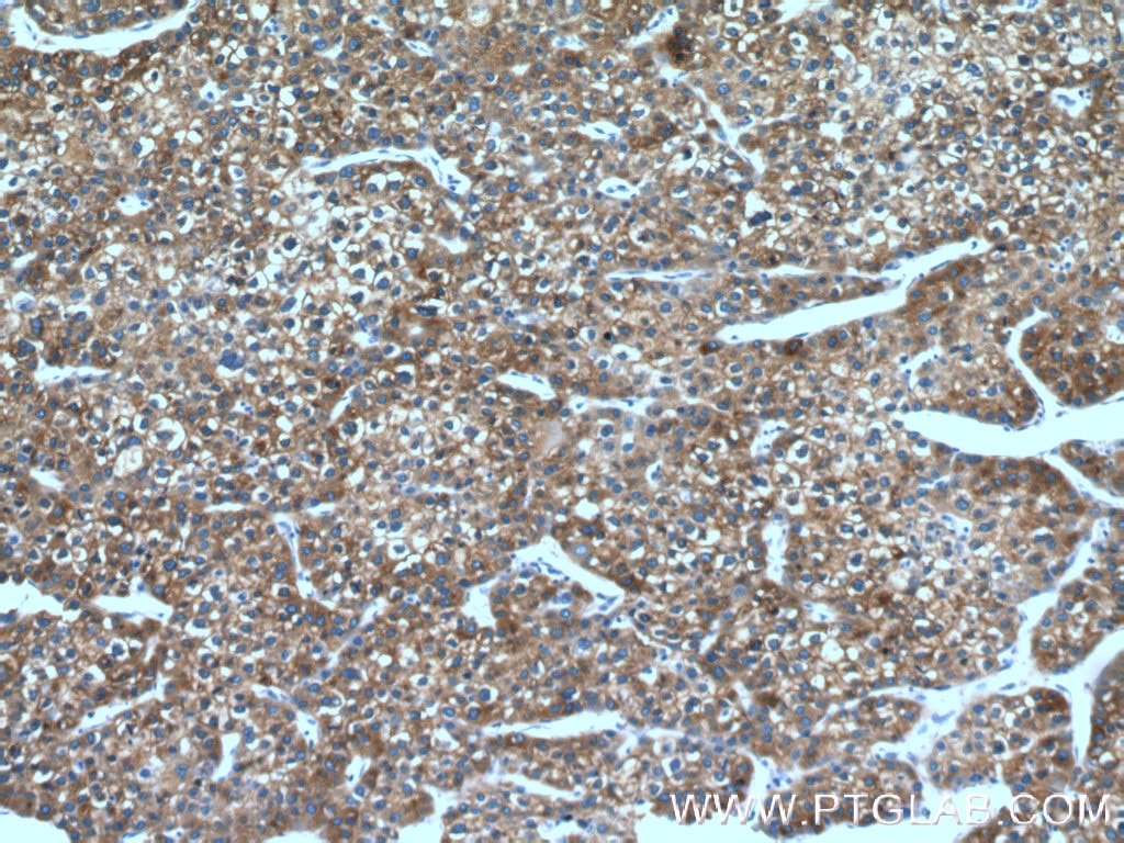 Immunohistochemistry (IHC) staining of human liver cancer tissue using FMO3 Polyclonal antibody (17469-1-AP)