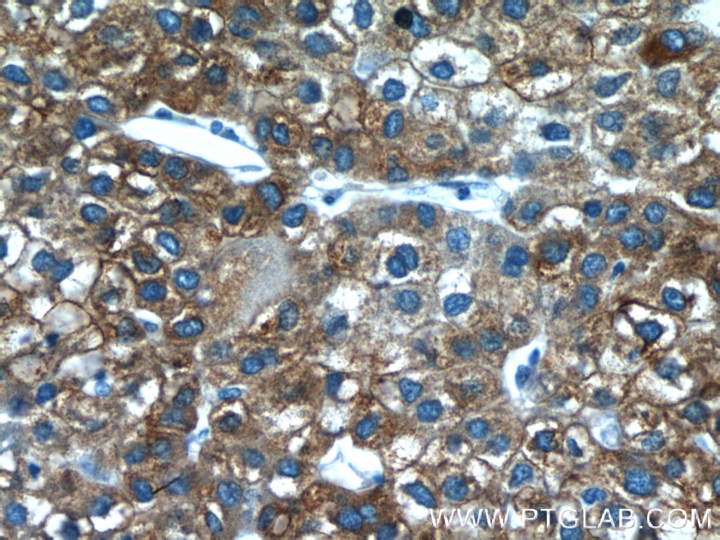 Immunohistochemistry (IHC) staining of human liver cancer tissue using FMO3 Polyclonal antibody (17469-1-AP)