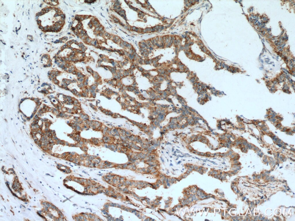 Immunohistochemistry (IHC) staining of human breast cancer tissue using FMO5 Polyclonal antibody (13699-1-AP)