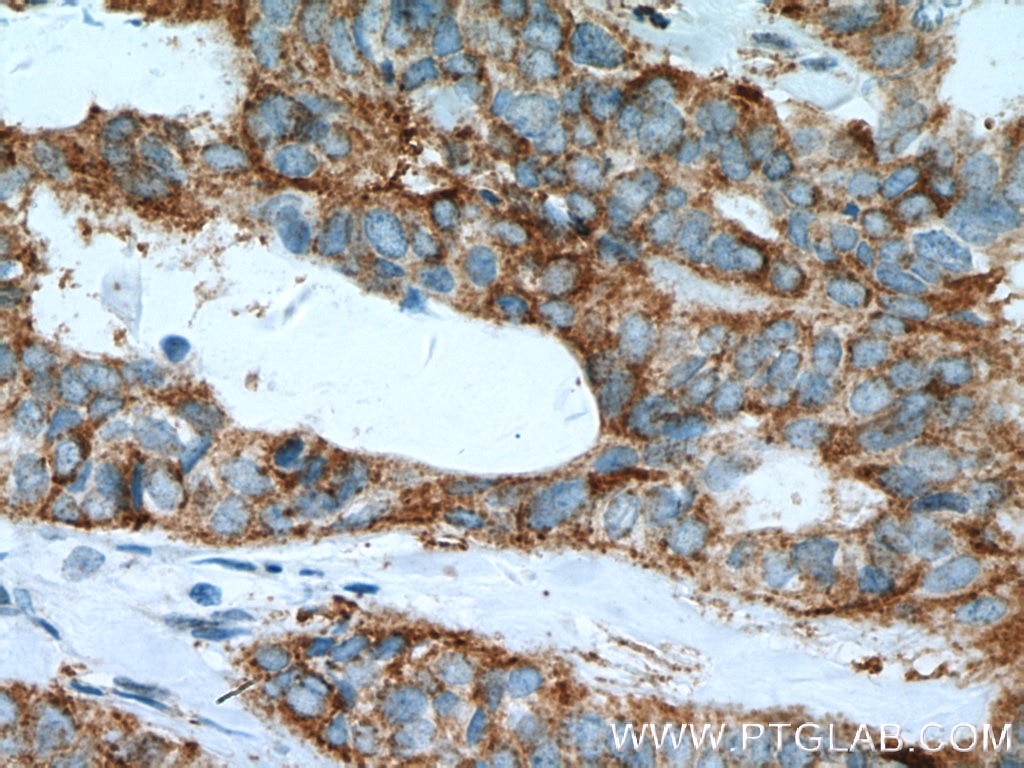 Immunohistochemistry (IHC) staining of human breast cancer tissue using FMO5 Polyclonal antibody (13699-1-AP)