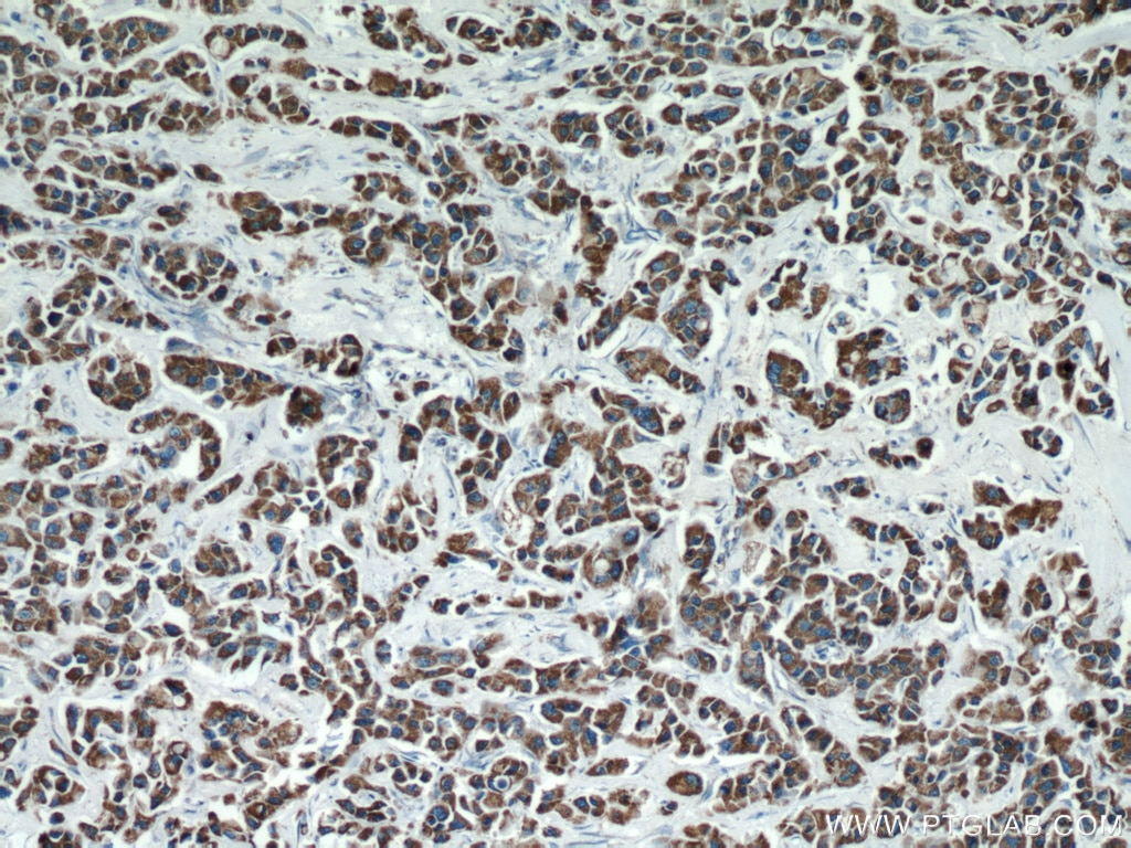 Immunohistochemistry (IHC) staining of human breast cancer tissue using FMO5-specific Polyclonal antibody (16864-1-AP)